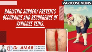 Bariatric surgery prevents occurance and recurrence of varicose veins.