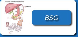 LAPAROSCOPIC BANDED GASTRIC SLEEVE SURGERY( BSG)