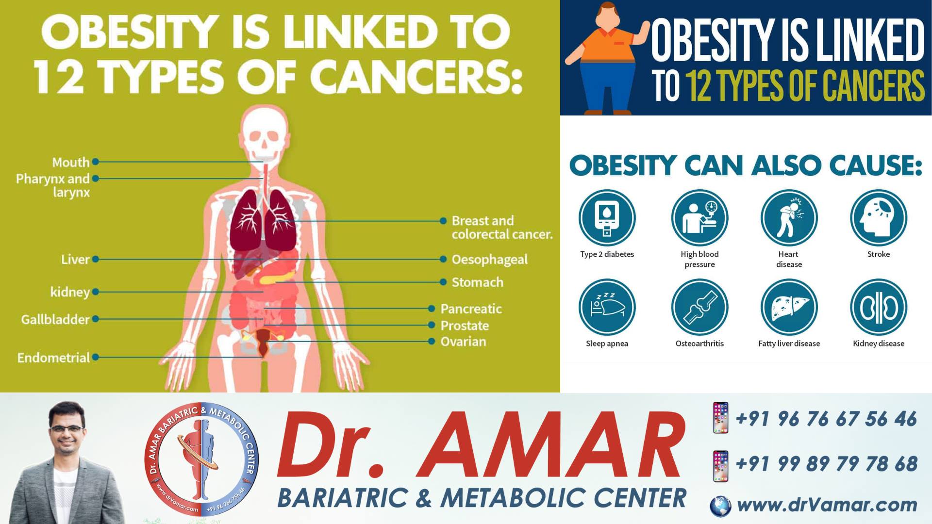 Obesity is linked to 12 different types of cancers