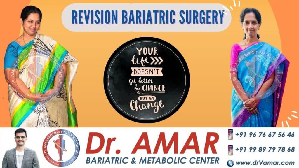 Mrs. Sridevi review opinion on revision bariatric surgery (sadi) – Best bariatric Surgeon